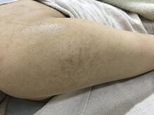 ナノハナ/鹿沼市本格全身脱毛ナノハナ