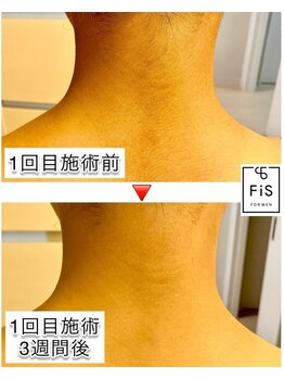 フィズ 津田沼店(FIS)/☆脱毛途中経過☆［津田沼］
