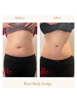 ルヴィショップ 沖縄(REVI SHOP)/痩身マシーンREVIスカルプト
