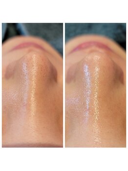 ラデュープラス(Radieux+)/韓国式3D毛穴洗浄