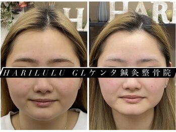 ハリルル 併設 GLケンタ鍼灸整骨院(HARILULU)/ハイパーナイフ