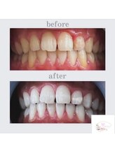 ホワイトニングショップ 本厚木店/【ビフォーアフター】10回