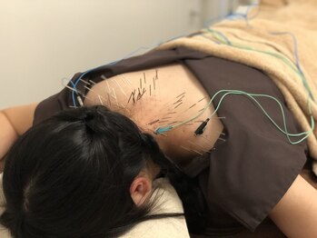 ビヨウハリセイタイ エヌサンテシンキュウチリョウイン(N サンテ針灸治療院)の写真/【通いやすい価格】～本場中国ハルビンで学んだ本格鍼施術～肩こり低周波鍼施術60分3750円(マッサージ付)