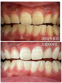 ホワイトニングスタイル 柏店/30分8来店 33000円