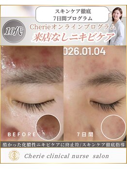 シェリー(Cherie)/施術なし！思春期ニキビケア