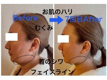 インフィニティ セルラム(INFINITY CELLULAM)/ビフォーアフター