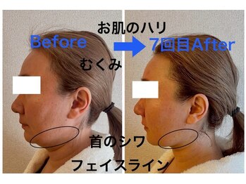 インフィニティ セルラム(INFINITY CELLULAM)/ビフォーアフター