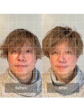 リュクス 恵比寿 代官山(LUXE)/施術（美容鍼）　Before After