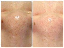 トータルビューティ ノイド(Noid)/毛穴洗浄&ピーリング　小鼻のみ