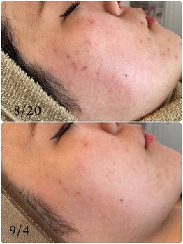 シュエット(Chouette)/韓国式ハーブピーリング一回施術