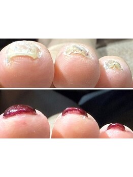 爪の悩みを解消できる（ケア含む）