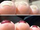 ミーア ネイル(Miiea nail)の写真/巻き爪ケアとジェルが同時にできるペディバランス♪施術後の痛みがほとんどなく大人気！ストレスフリー◎