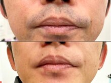 セルフメイド 東大阪店(SELFMADE)/髭脱毛ビフォーアフター