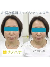 ナノハナ/鹿沼市本格全身脱毛ナノハナ