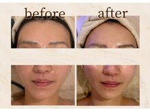 アンバー 恵比寿(AMBER)/ハーブ×ハイドラフェイシャル