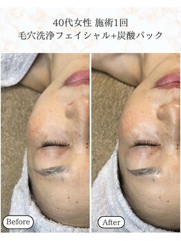 シーフェイス 横浜店(SEE FACE)/毛穴洗浄フェイシャル炭酸パック