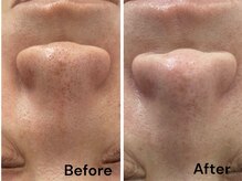 ブライトプラス(BRIGHT+)/ハイドロフェイシャル毛穴洗浄