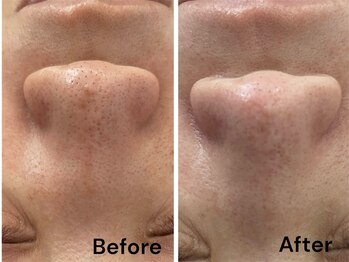 ブライトプラス(BRIGHT+)/ハイドロフェイシャル毛穴洗浄