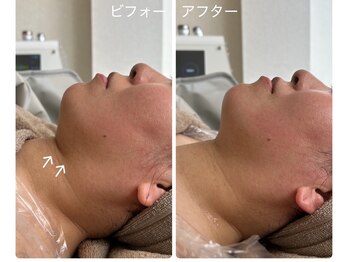 ミヨンビー(miyong.B)/1度で顎がスッキリ!