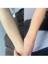 トゥインクル(Twinkle)/チクチク目立つ毛穴も！