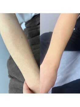 トゥインクル(Twinkle)/チクチク目立つ毛穴も!