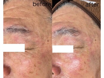 ラヴァンド(Lavande)/【ホワイトスノーピール 症例】