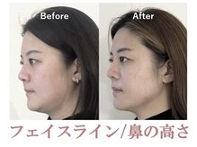 ラプリ 盛岡店(Raplit)/隆鼻＋輪郭矯正40分10回