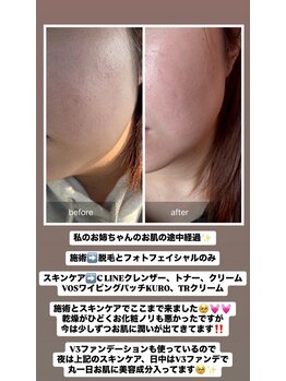 ルクール(Le Coeur)/人気!フォト光フェイシャル♪