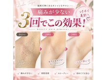 リアン(lien)の雰囲気（毛質に合わせた脱毛機で夏に向けてツルスベ肌に♪）