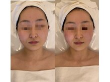 ナラビューティー(NARA BEAUTY)/コルギ1回効果