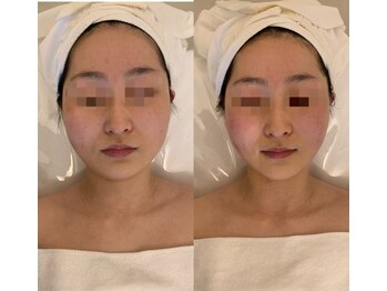 ナラビューティー(NARA BEAUTY)/コルギ1回効果