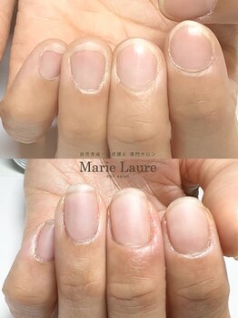 マリーロール 梅田店(Marie Laure)/自爪育成/深爪矯正/ネイルケア
