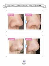 サロン エイトミー(salon 83)/【毛穴ケア】いちご鼻改善