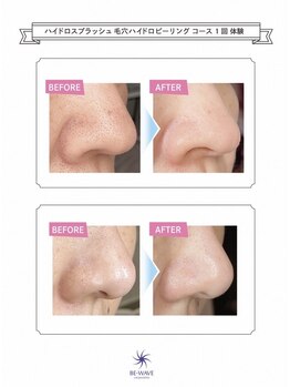 サロン エイトミー(salon 83)/【毛穴ケア】いちご鼻改善