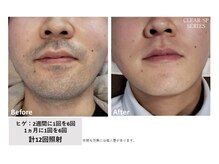 ラフ(LaFF)/ヒゲ脱毛Before＆After