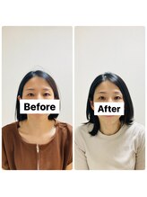 アレス鍼灸整体サロン/目ぱっちり・フェイスライン