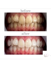 ホワイトニングショップ 本厚木店/【ビフォーアフター】10回