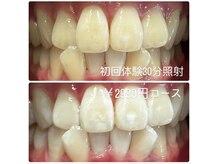 ホワイトニングルーム 川崎店(WhiteningRoom)/ホワイトニング/川崎　