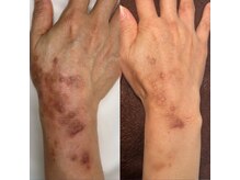 ルイース(LOUISE.)/プロセルセラピーズボディ