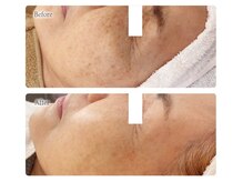 オービーエム 博多阪急店(O.B.M)/【70代シミケア症例】