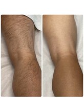 GOLF & MEN'S BEAUTY &nbsp;TAKUMI/脱毛