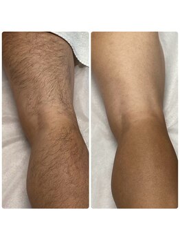 GOLF & MEN'S BEAUTY &nbsp;TAKUMI/脱毛