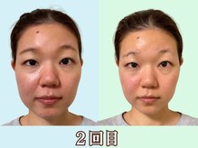 ナチュラルパーフェクトフェイス 新宿/2回目が変わる／新宿駅小顔