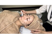 メゾン カルム 天文館店(MAISON CALME)の雰囲気（大人気メニューエピダーマルスキン）