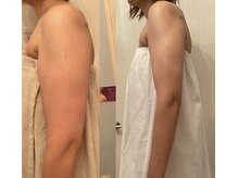 メゾン アンジュ(Maison Ange)/二の腕4回目／レモンピール