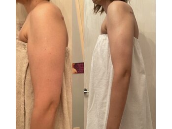 メゾン アンジュ(Maison Ange)/二の腕4回目/レモンピール