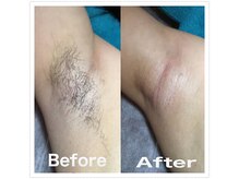 フィオーレ/スキンケア美肌脱毛☆白いお肌に