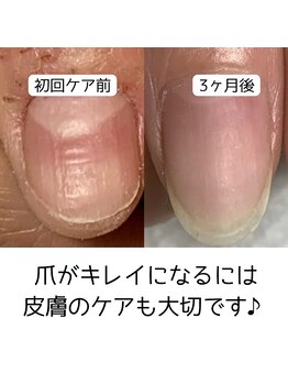 カンパニュラ(Campanula)/手荒れも改善!自爪育成