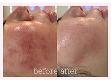 ブライス(BLITHE)/before after