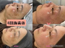 トレ(thore.)の雰囲気（色素トラブル、くすみやお肌のキメまでなめらかに。）